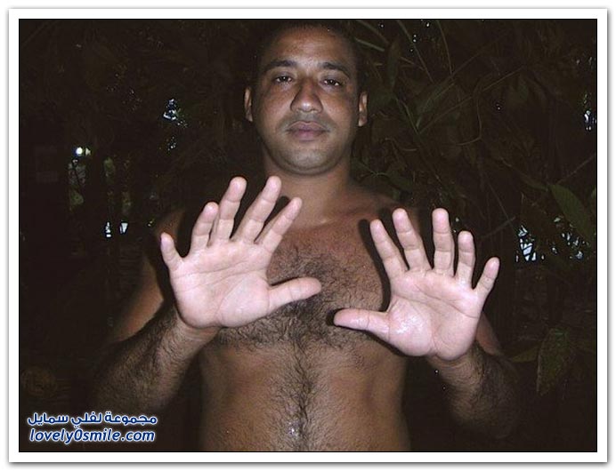رجل كوبي لديه 24 اصبع