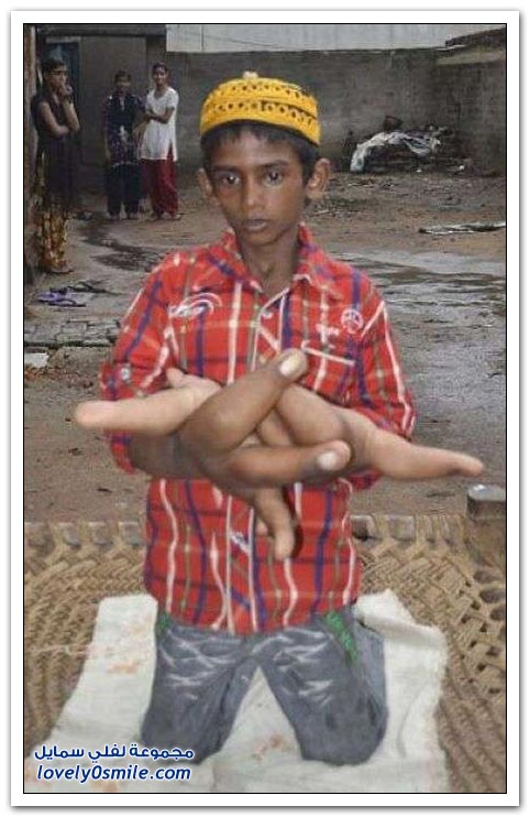 طفل عمره 8 سنوات بأيدي كبيره تزن 8 كم لكل يد