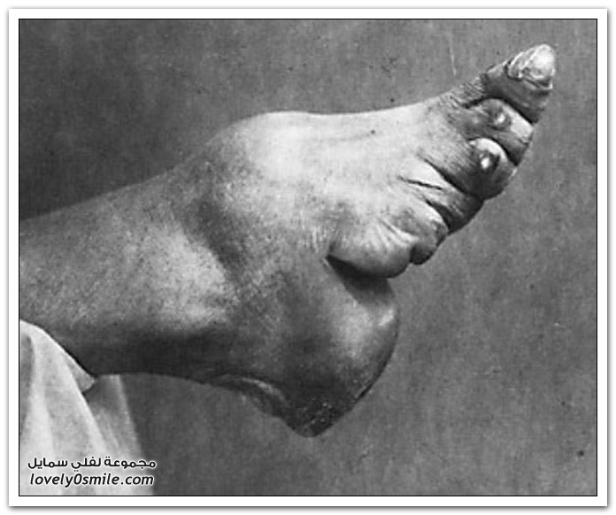سر الأقدام الغريبة عند الصينيات